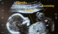 /album/fotogaleria/a323655-import-ultrazvuk-sono-embryo-plod-dieta-foto-baby-web-dieta-jpg/